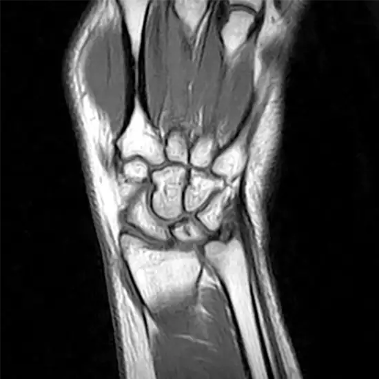 MRI Screening Wrist